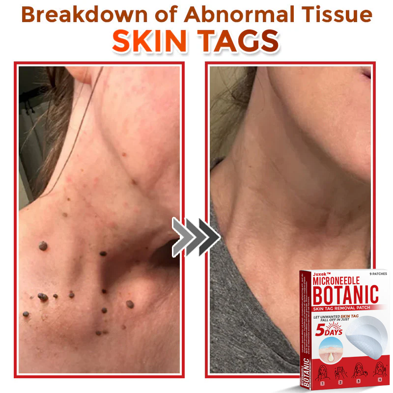 Juxek™ Removal Patch: Gentle Microneedle Patches for Skin Tag & Mole Removal