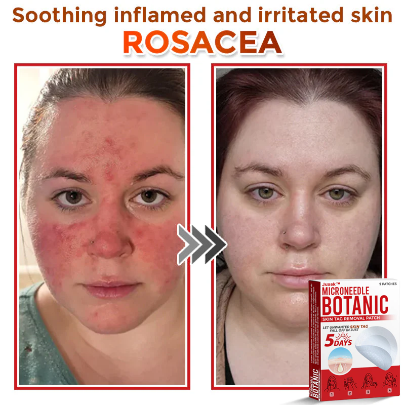 Juxek™ Removal Patch: Gentle Microneedle Patches for Skin Tag & Mole Removal